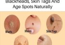 Natural remedies for treating age spots, moles, skin tags, warts, and blackheads